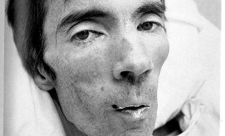 A black-and-white photograph of an emaciated man in a tight close-up of his gaunt face. His cheeks are sunken and his chapped lips are covered with a white residue.